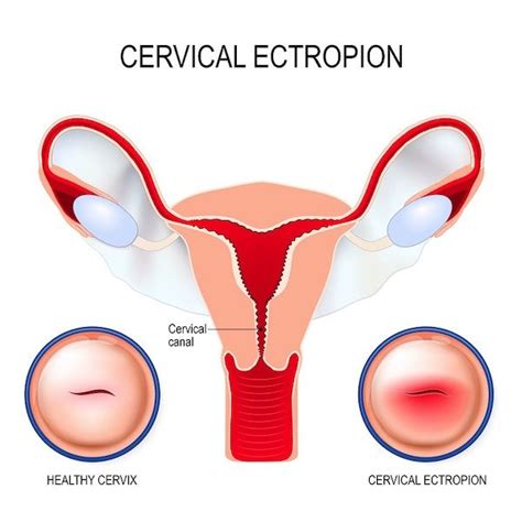 Cervical Ectropion: Symptoms, Causes, and More ivfholymothers