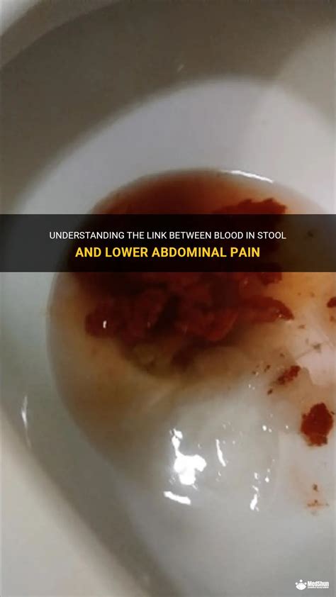 Understanding The Link Between Blood In Stool And Lower Abdominal Pain ...