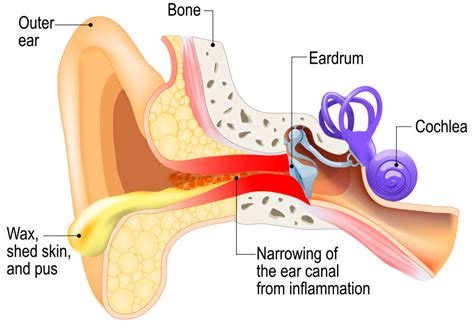 Outer Ear Infections — ENT Surgeon East Sydney, Edgecliff | Dr Marco ...