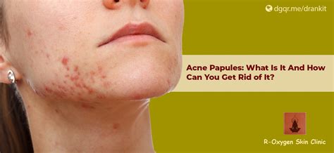 Acne Papules: What Is It And How Can You Get Rid of It?