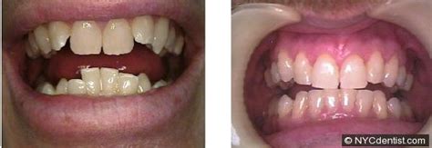 Removable Dental Braces – Before and After Photos