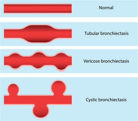 Causes, Symptoms, Diagnosis and treatment of bronchiectasis | Holistic ...