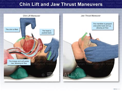 Chin Lift and Jaw Thrust Maneuvers - TrialQuest Inc.