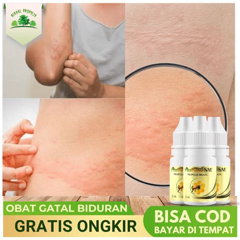 Obat Kaligata Anak & Dewasa – Obat Biduran Alami – Obat Gatal Gatal ...