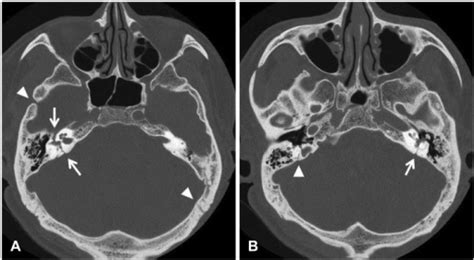 Two slices of preoperative temporal bone CT axial scan. | Open-i