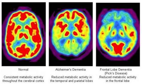 PET/CT in Neurology | Transforming Epilepsy & Dementia Care | Akumin