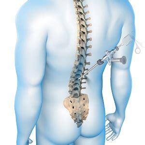 Endoscopic Spine Surgery | Neuroscience Specialists | Neurosurgical ...