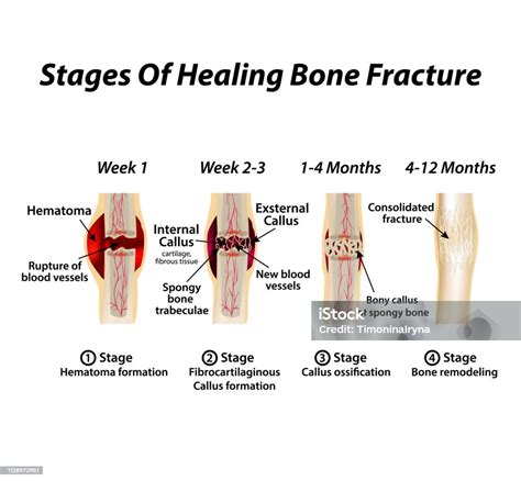 Stages Of Healing Bone Fracture Formation Of Callus The Bone Fracture ...