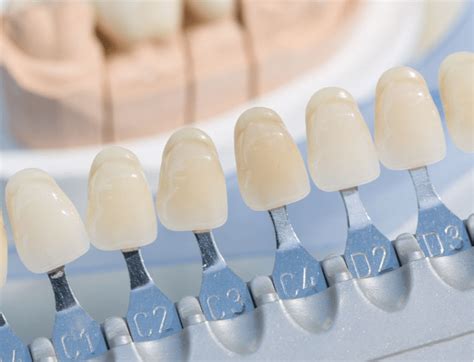 Porcelain Cosmetic Crown in Ypsilanti, MI | Avenue Dental