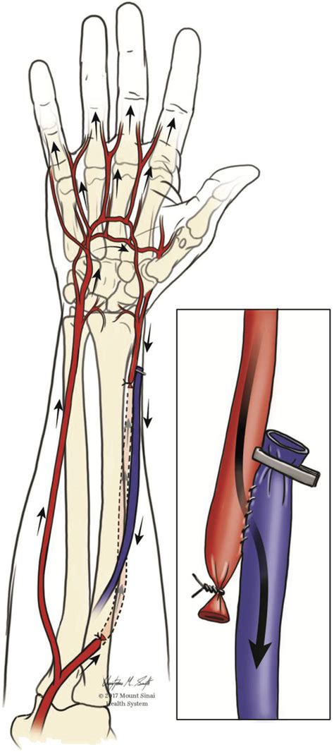 Radial Artery Location