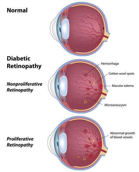 Diabetic Retinopathy – Petrou Eye Care