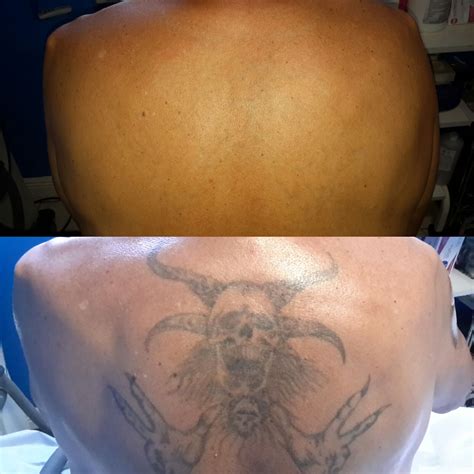 Looking For "Tattoo Removal Near Me" In Orlando? Call Us!