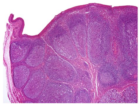 Pharyngeal Tonsils Histology Labeled