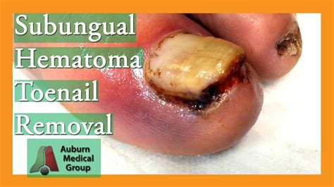 Subungual Hematoma Infection