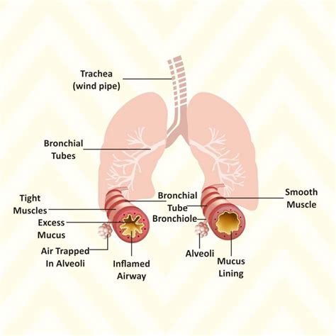 Asthma Attack in Children: Causes, Early Warning Signs, and Treatment ...