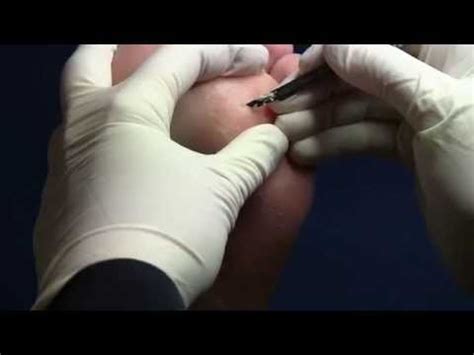 Corn and Callus Removal by The Foot Doctor at Irymple Foot Clinic - YouTube