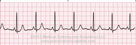 Sinus Rhythm ECGs