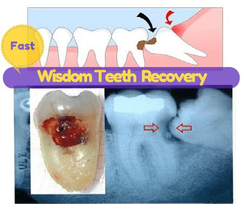 Wisdom Teeth Recovery Tip, Foods, 1st, 2nd 3rd Day & Precautions