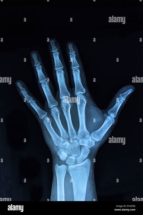 Broken bone xray hi-res stock photography and images - Alamy