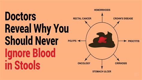 Best Blood On Stool Hemorrhoid of the decade Learn more here | stoolz