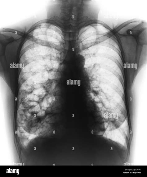 Bronchiectasis Chest X Ray