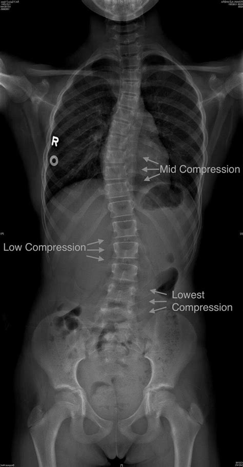 Read and Interpret X-ray and Radiologist’s Report for Scoliosis — Lyons ...