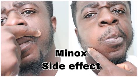 slsi.lk - how long for sulfatrim to work | Are minoxidil side effects ...