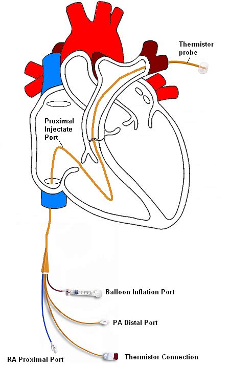 Swan-Ganz catheter - Google Search | Icu nursing, Critical care nursing ...