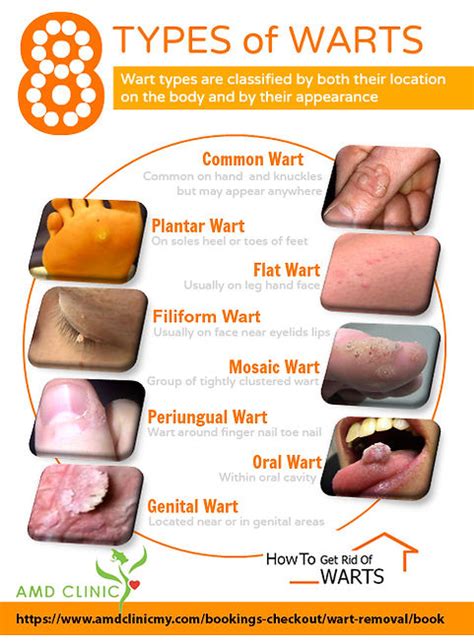 WART REMOVAL | AMD CLINIC | JOHOR BAHRU