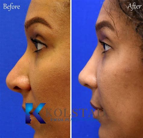 African American Wide Nose Surgery 15 | Dr. Kolstad - San Diego Facial ...