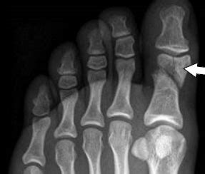 Great (big) toe fracture or injury | CUH