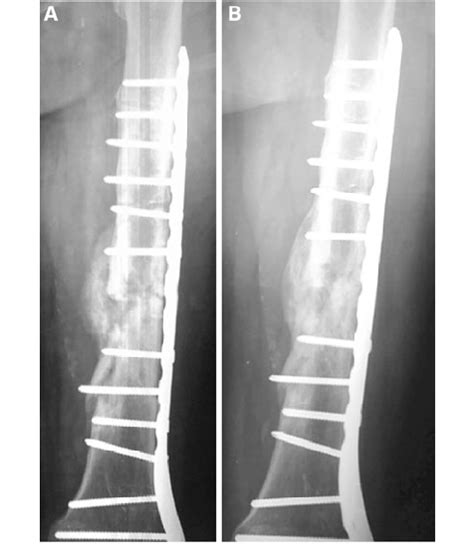 Anteroposterior radiograph shows the callus formation due to secondary ...