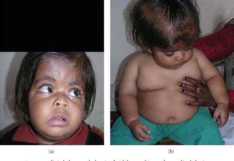 Figure 1 from MOMO Syndrome with Holoprosencephaly and Cryptorchidism ...