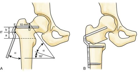 Femoral Osteotomy | Plastic Surgery Key