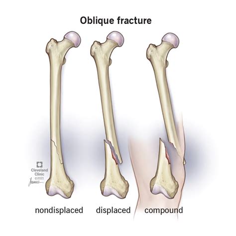 Oblique Fracture: Symptoms, Causes & Treatment