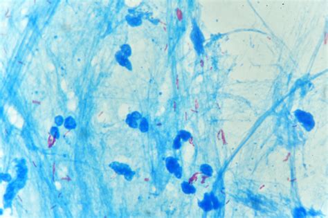 Mycobacterium Positive In Acid Fast Stain Sputum Stock Photo - Download ...