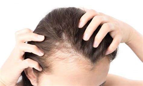 Female pattern baldness: Causes, treatment, and prevention