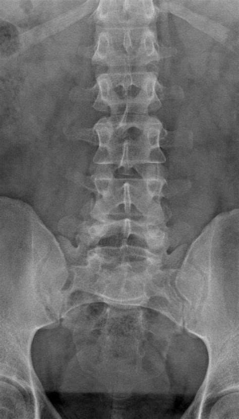 L-Spine Anatomy (X-Ray) Quiz - By bfurse