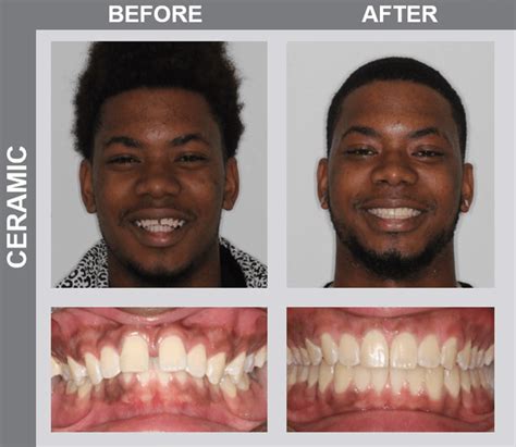 Teeth Before And After Braces Crowding