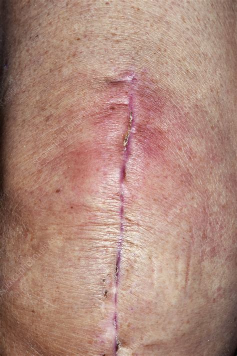 Infected knee replacement surgery wound - Stock Image - C028/4376 ...