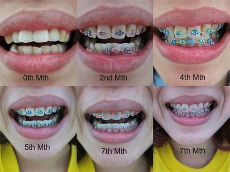 √ Top Braces Colors