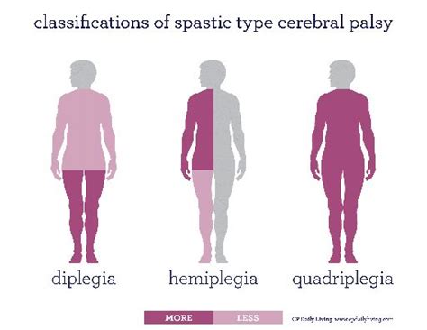 Spastic Cerebral Palsy | Cerebral Palsy Research Network