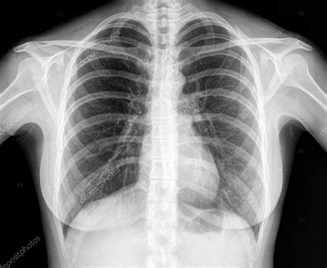 X-Ray Image Of Human Healthy Chest — Stock Photo © jovannig #11802437