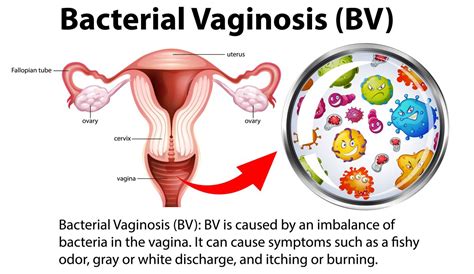 Bacterial Vaginosis (BV): Causes, Symptoms, and Treatment