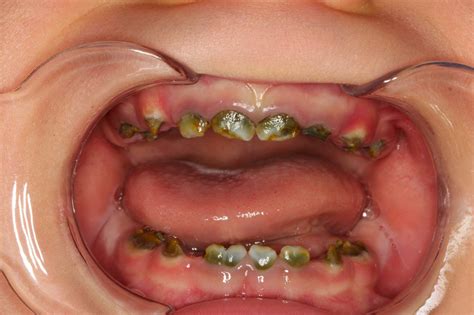 Green Teeth? The Many Shades of Congenital Syphilis - Oral Health Group