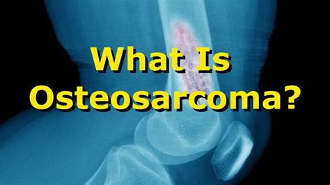 Osteosarcoma Symptoms