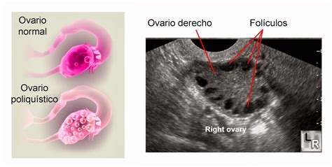 Dr. Síndrome de Ovarios Poliquísticos Managua: Ovario poliquístico