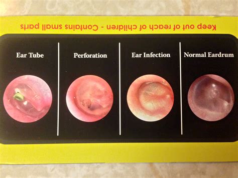 Ear Canal Infection Diagram at George Alvarez blog