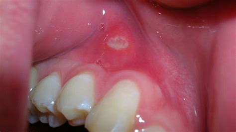 Painful Lump In Floor Of Mouth | Viewfloor.co