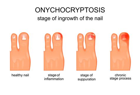 Ingrown Toenail Pain Treatment | Ingrown Toenail Doctor Eastvale, Norco